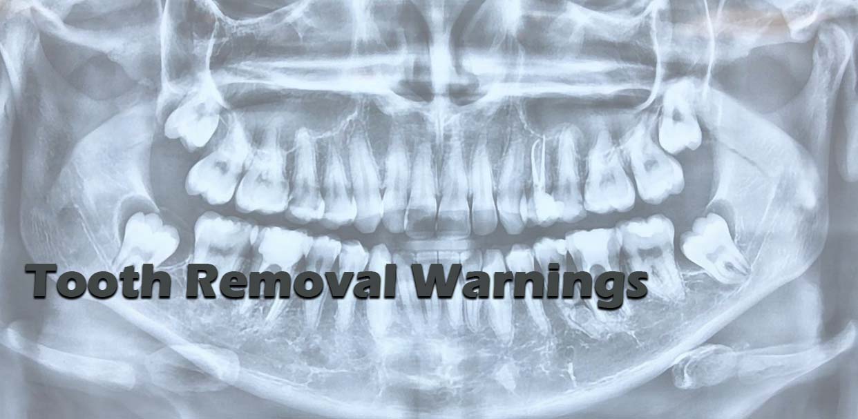 Tooth Removal Warnings